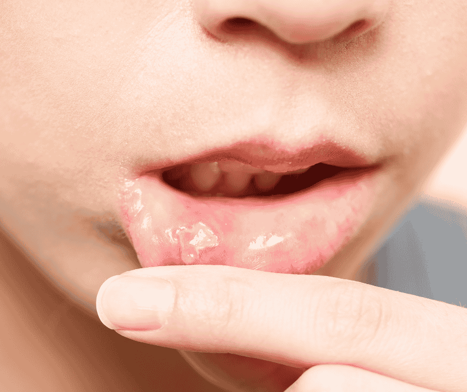 Homeopatika a tkáňové soli na afty v ústech